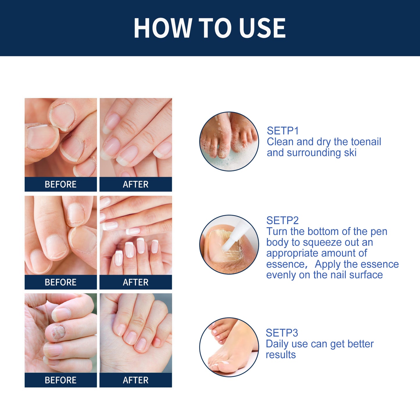 Nail Repair Essence Pen - Moisturizing Nail Treatment for Damaged Nails