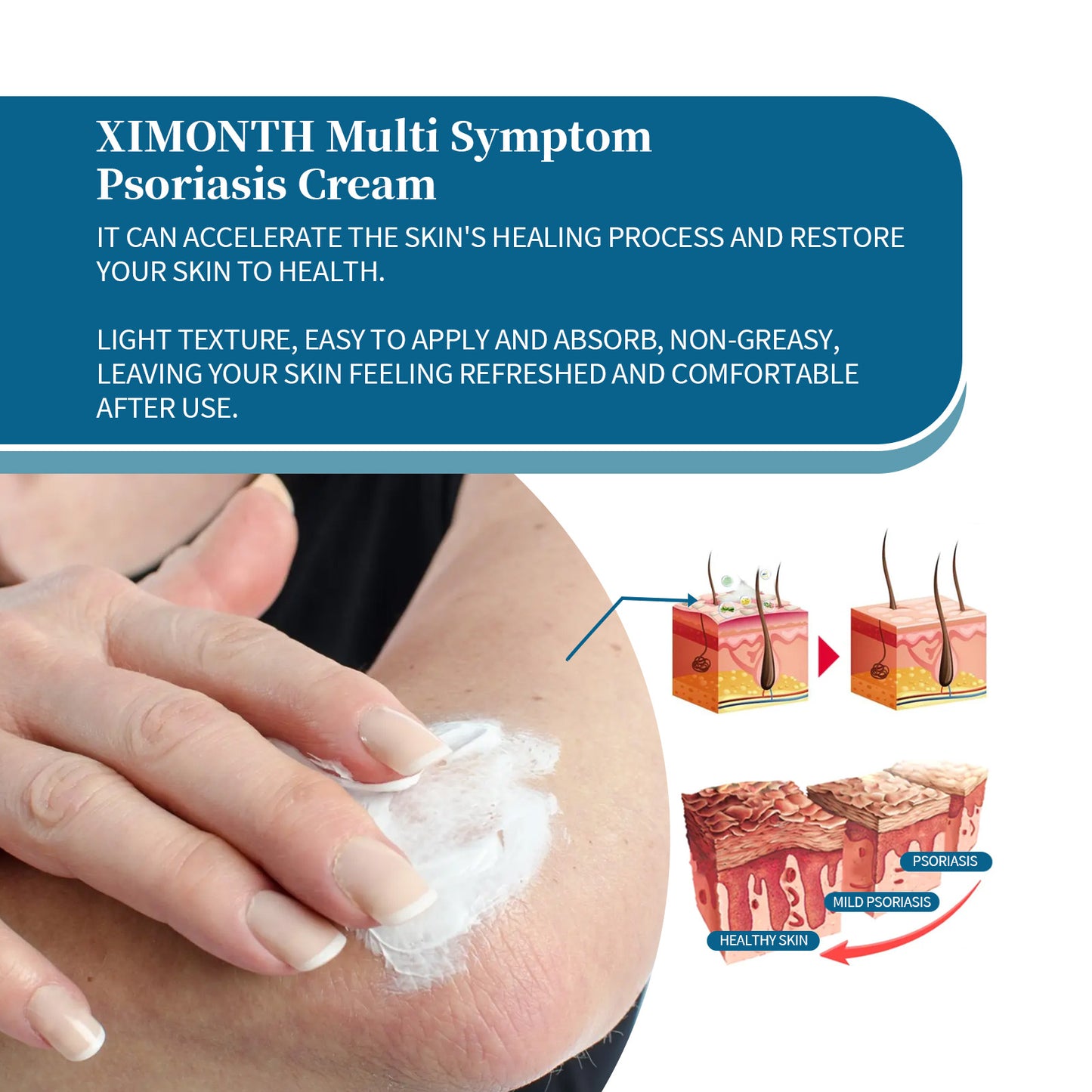 Psoriasis Relief Cream - Moisturizing Skin Repair for Hand, Foot & Body