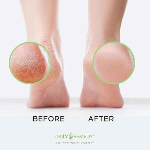 Foot Callus Remover Gel Set - Professional Callus Remover for Feet, Calloused Feet Remover Gel - Pedicure Kit & Foot Spa Tools - Feet Callus Remover - 8oz w/ 16oz Tea Tree Oil Foot Soak - USA