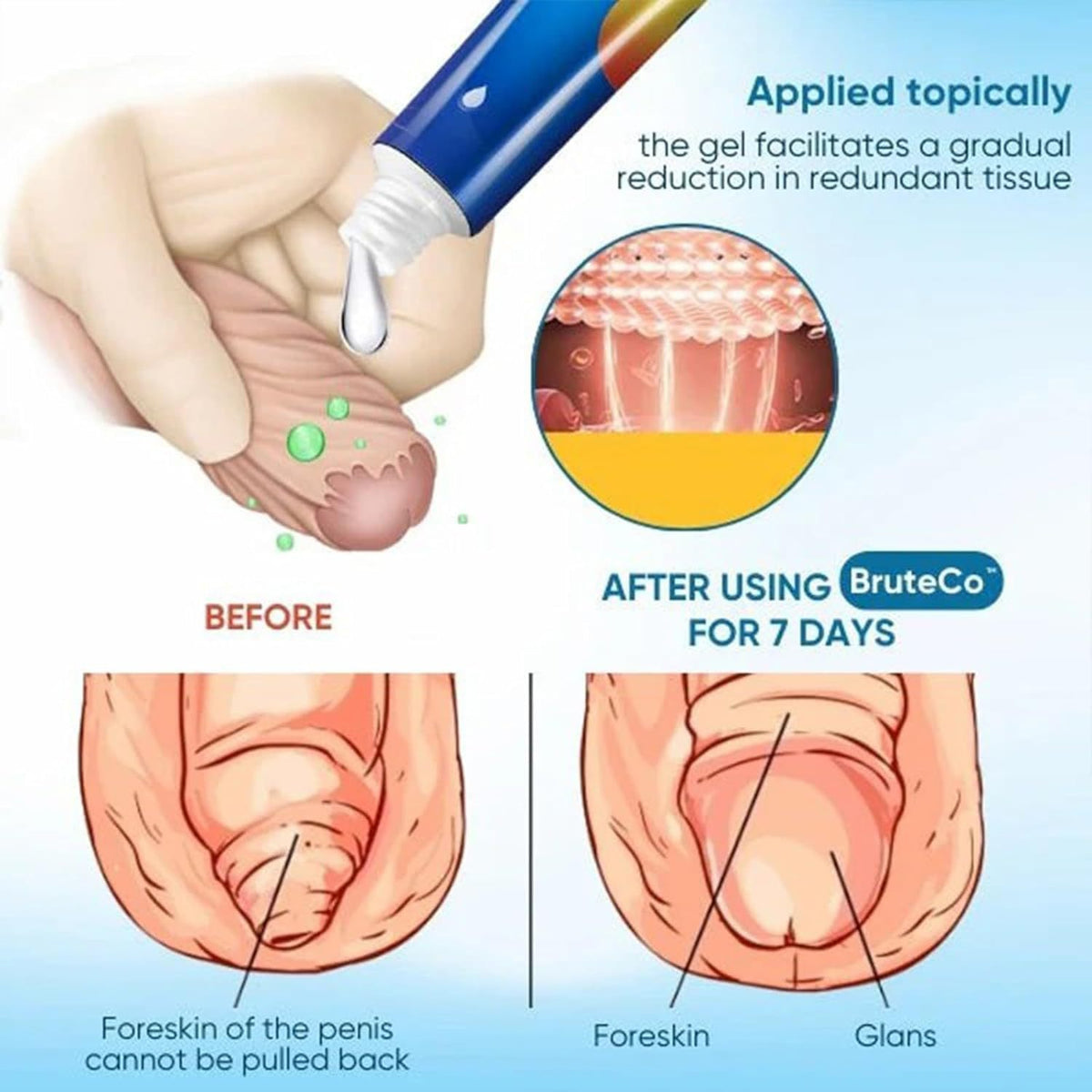 Prepuce Correction Gel