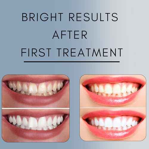Teeth Whitening Gel for Trays - Pro Strength 44% Carbamide Peroxide, 5 Syringes (50 Treatments) + 2 Trays ? Enamel Safe, Removes Coffee & Other Stains