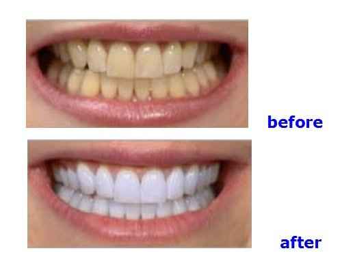 Professional De!ntal Portable Teeth Whitening Machine LED Bleaching Accelerator Light Lamp YS-TW-A