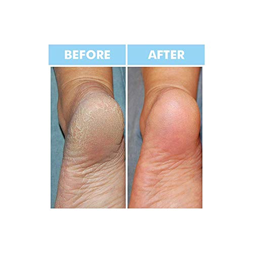 Bodipure Premium Hand and Foot Mask | Moisturizing Kertain Gloves & Socks | Hydrating Dull Dry Hands, Cracked Heels, Callus Softening & Nail Strengthening | Chemical-Free Feet Treatment | (6+6 Pack)