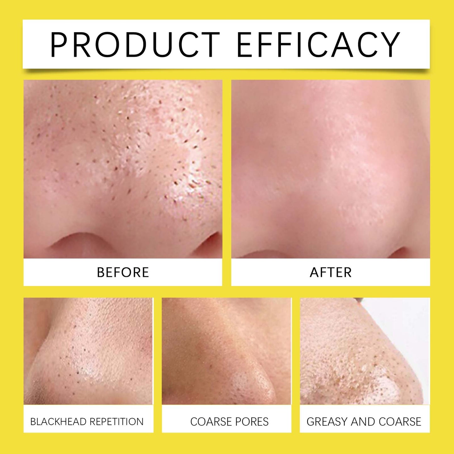 Hydrocolloid Nose Patch for Blackhead Removal & Pore Cleaning