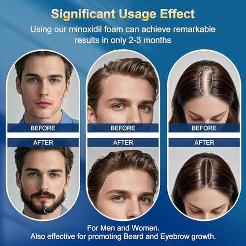 5% minoxidil foam for men-5pack£¬ Infused with Biotin, Hair Growth Treatment, Supports Thicker and Fuller Hair & Beard (10.5oz, 5 Month Supply)