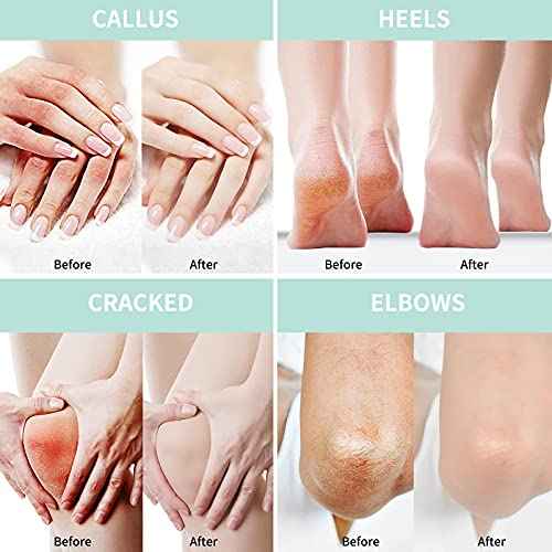 Grocerism Urea Cream 40 Percent For Feet Plus 2% Salicylic Acid 5.29 oz || Foot Cream and Hand Cream Maximum Strength with Hyaluronic Acid,Tea Tree,and Aloe Vera For Deep Moisturizes,Callus Remover