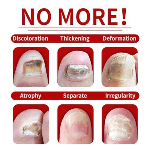 Ginger Nail Treatment Serum - Moisturize the Cuticle & Strengthen Nails and Helps Nails Healthy Grow, 1 fl.oz (Pack of 2)