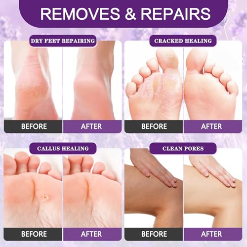 Foot Callus Remover Gel Foot Files Kit Heel Foot Callus Remover Gel Exfoliator Dead Skin Remover Pedicure Foot Spa Products Home Pedicure Foot Spa Supplies for Rough, Dry, Cracked Skin