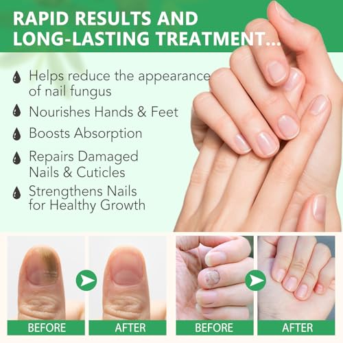 Ginger Nail Growth Strengthener Serum ? Ginger-Infused Nail Repair Oil for Care, Natural Nail and Strengthener Solution