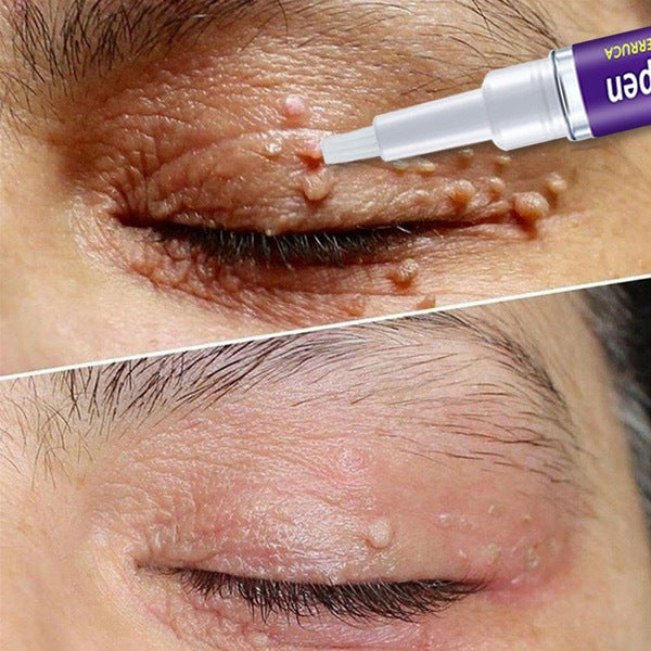 Skin Cleansing Care Pen 1pc 1box