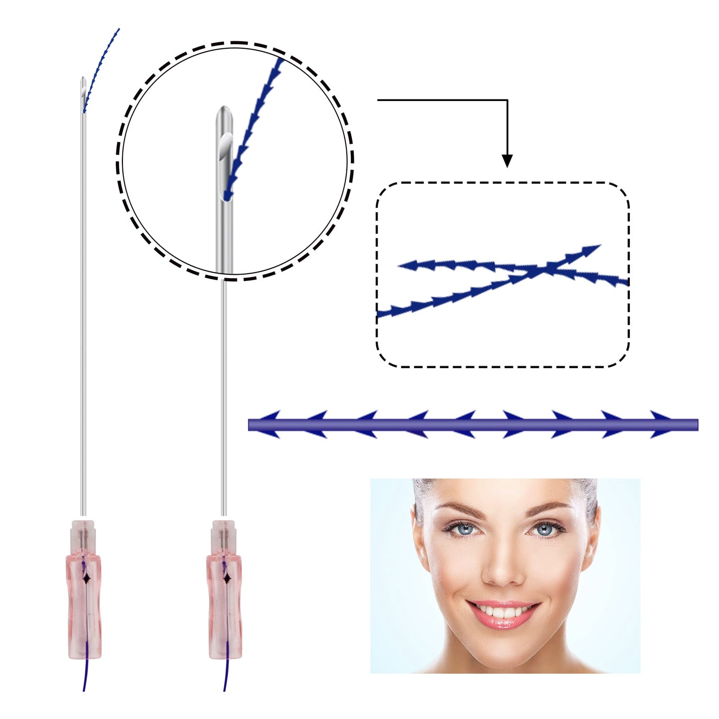 HYPOD Pdo Threads Lifting Fishbone, Pdo Thread Curved Barb 360 Degree Spiral Two Way Barb 16pcs, 18G100mm