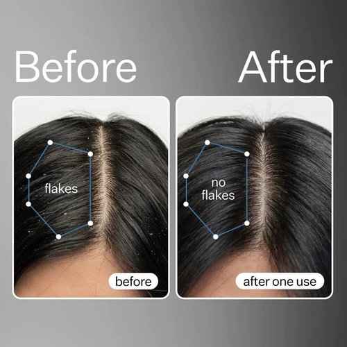 Act+Acre Cold Processed Vitamin E Scalp Detox Oil and BHA Salicylic Acid Exfoliator - For Dandruff and Dry Itchy Scalp - Hair Growth Treatment for Thinning Hair - Exfoliating Mask for Itch