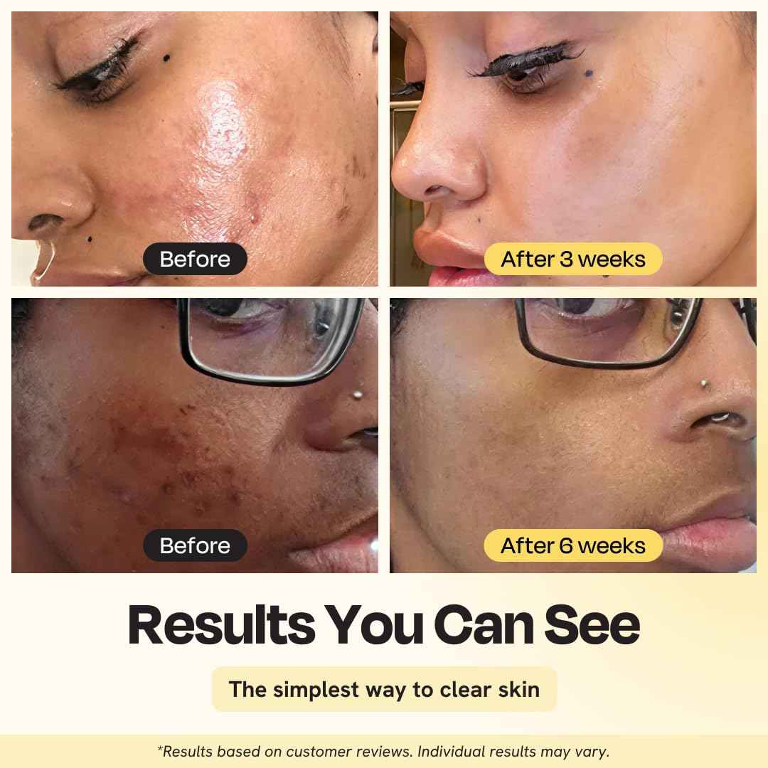 Gleamin Vitamin C Clay Mask for Dark Spots, Turmeric Clay Face Mask Skin Care, Deeply Cleanses & Refines Pores, Brightens Uneven Tone and Helps Improve Post-Blemish Scarring & Texture - 5 Oz