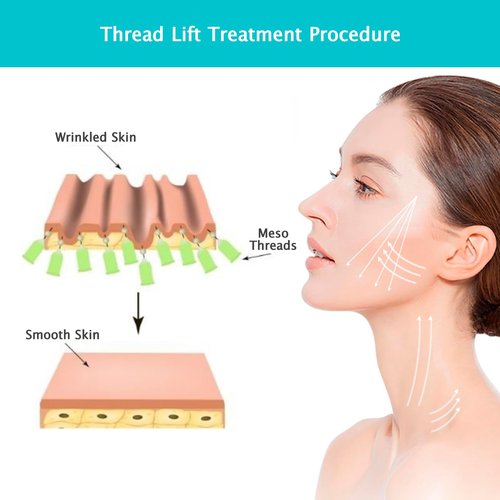 RYZESKI PDO Screw Thread, Lift Face Tip Screw Threads, PDO Threads Face Lifting Face & Whole Body (100PCS-29G*38mm)