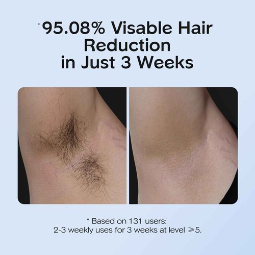 INNZA IPL Hair Removal with Ice Cooling Care Function for Women,Long-Lasting Results,999,999 Flashes Painless Hair Removal, Hair Removal Device for Armpits Legs Arms Bikini Line