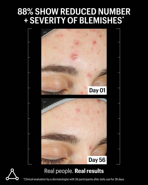 Allies of Skin Azelaic & Kojic Clarifying Face Serum | Clinically Proven for Acne & Blemish Prone Skin |10% Azelaic Acid Treats Pigmentation and Redness | Targets Pores & Uneven Skin Texture (1 Fl oz)