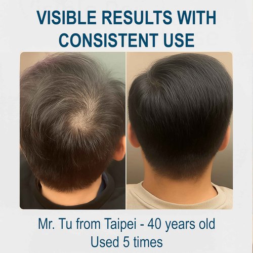 LA EXO Biochemical Pulse Exosome Hair Growth Serum Care Solution for Hair Density, Reduces Shedding and Promotes a Healthy Scalp | Daily Strengthening Treatment for Weak or Damaged Hair | 30ml