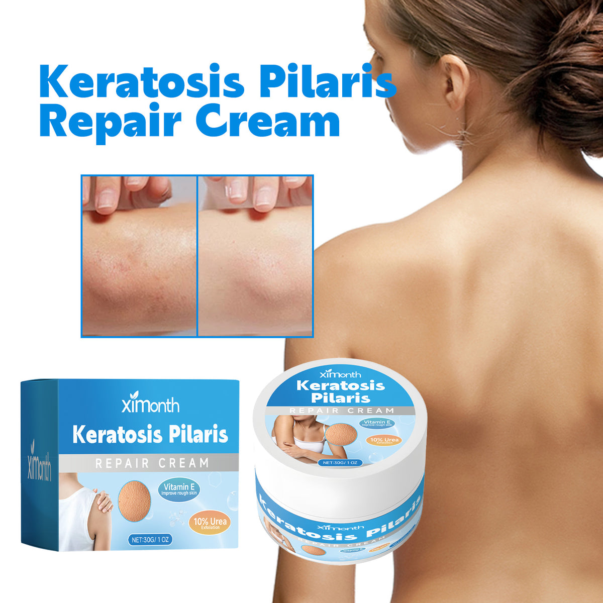 Keratosis Pilaris Repair Cream - Urea Exfoliating Body Lotion