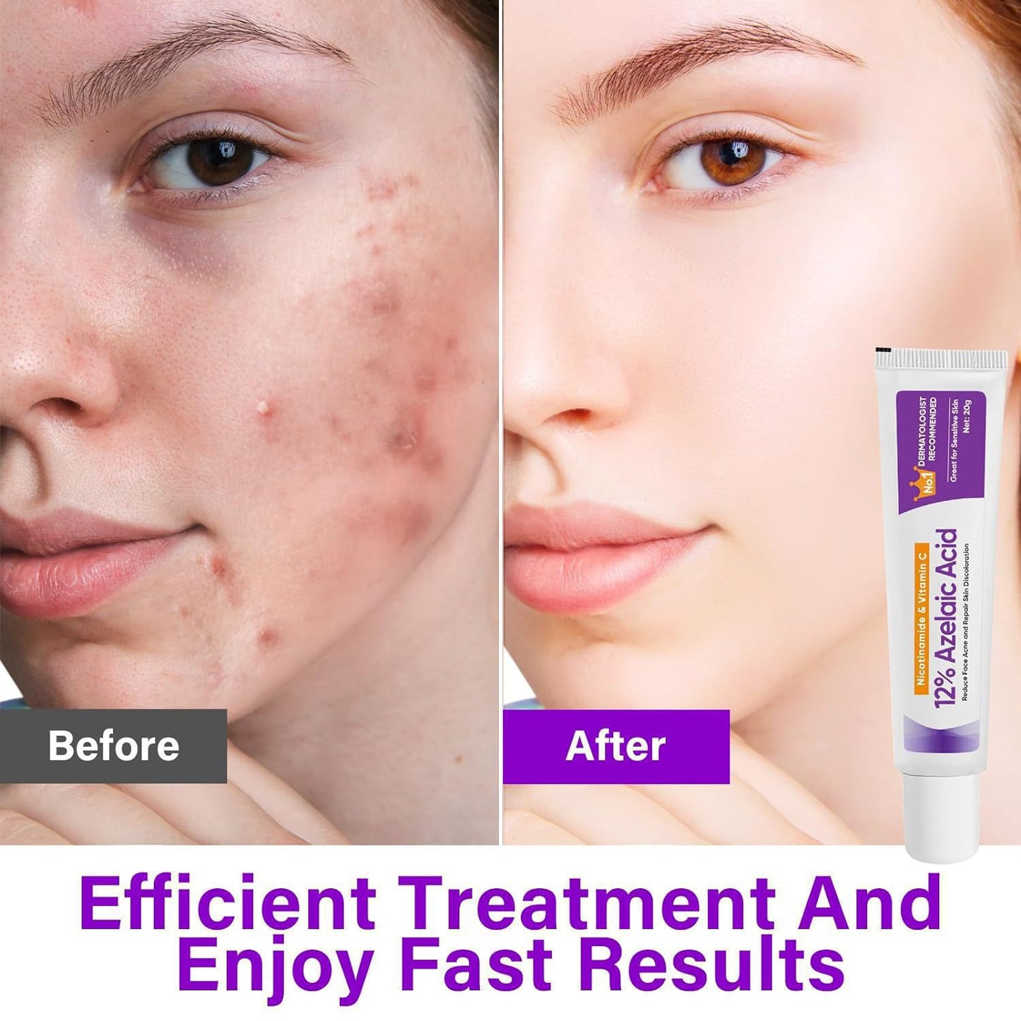 Azelaic Acid Face Serum 20g - Acne, Pigmentation & Brightening Treatment