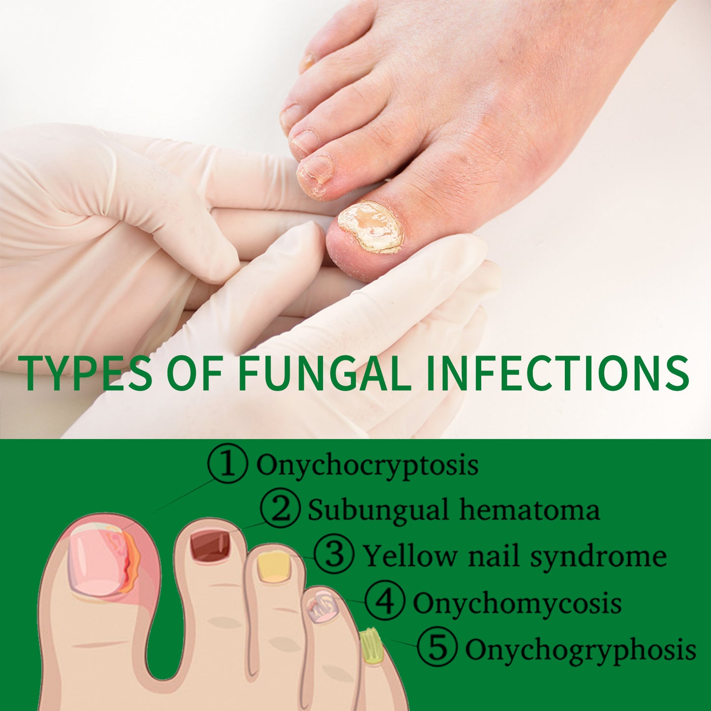 Ginger Nail Repair Solution for Fungal Treatment and Nail Restoration