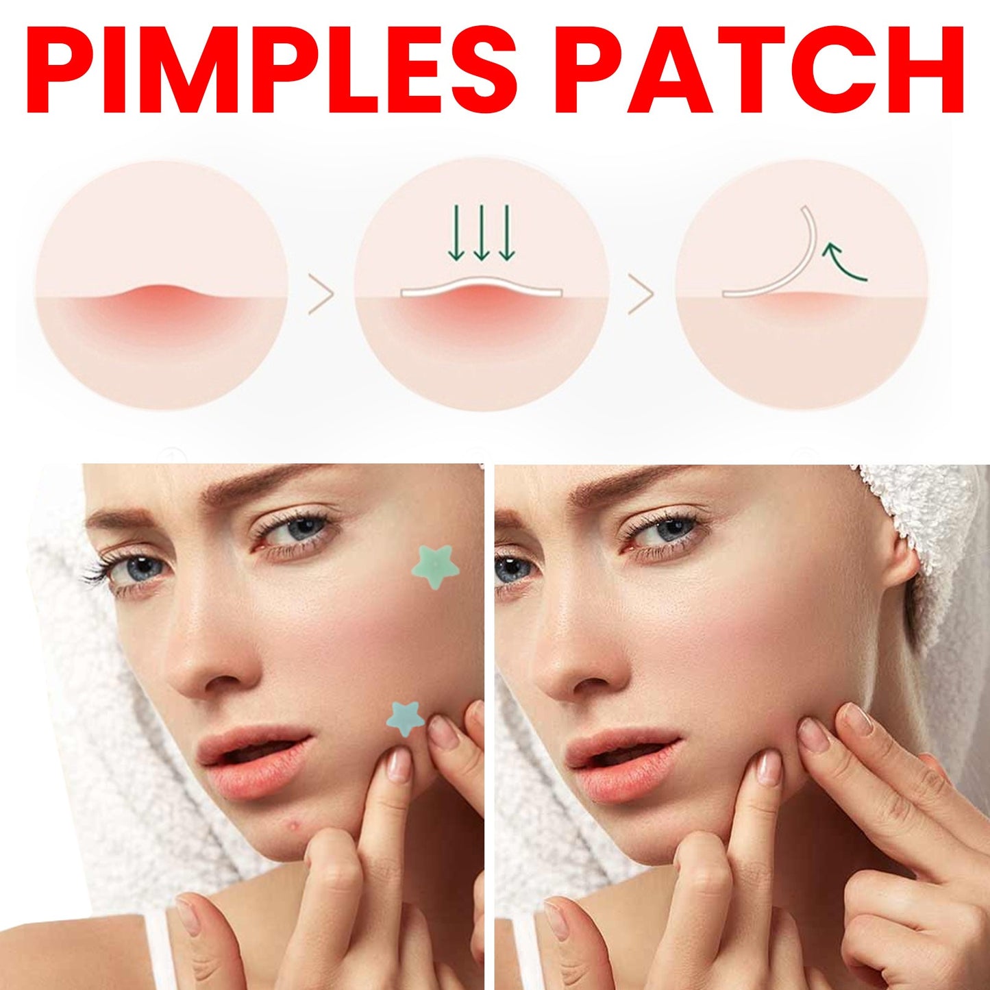 Hydrocolloid Acne Patches - 200 Count Invisible Blemish Spot Treatment