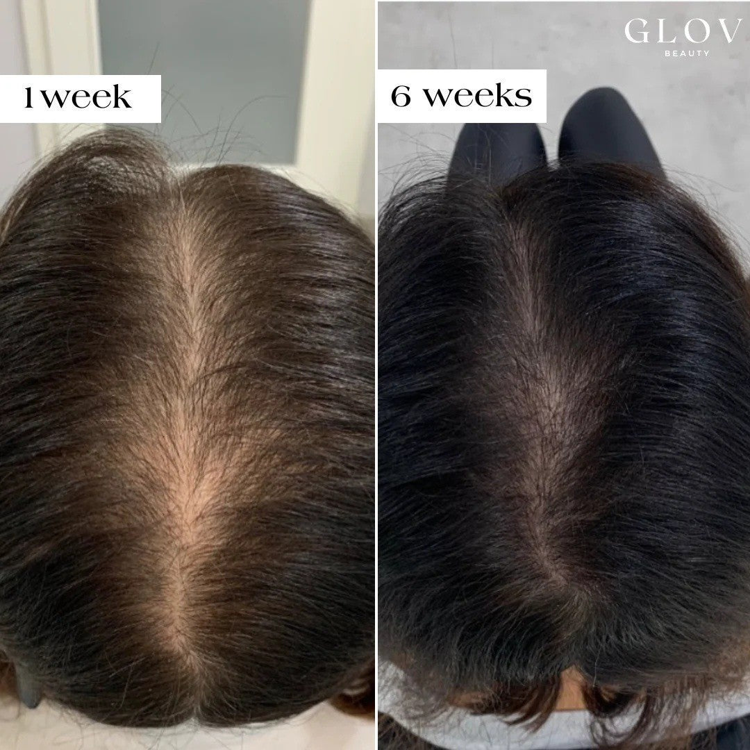 Hair Growth Microneedle Serum - 12 Vials for Hair Loss & Thinning