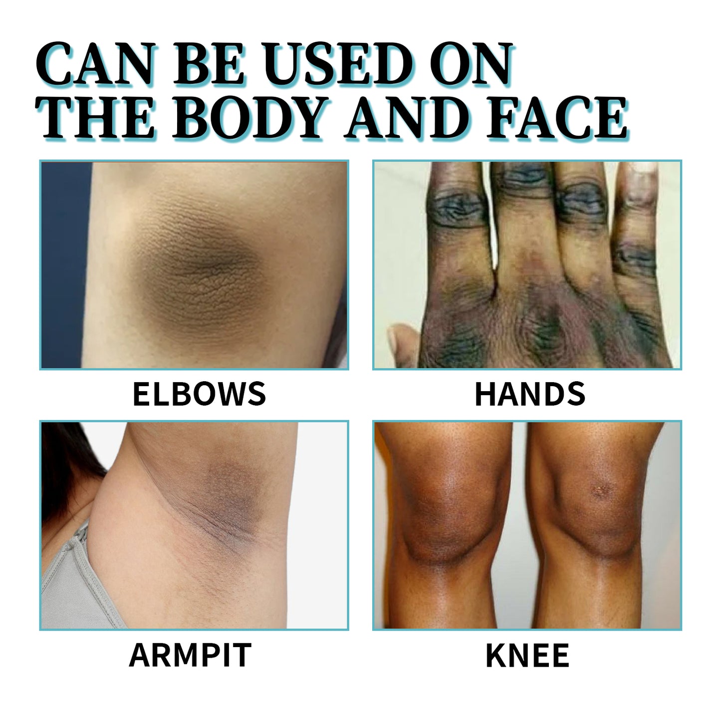 Acanthosis Nigricans Therapy Lotion - Dark Spot Corrector for Skin Repair