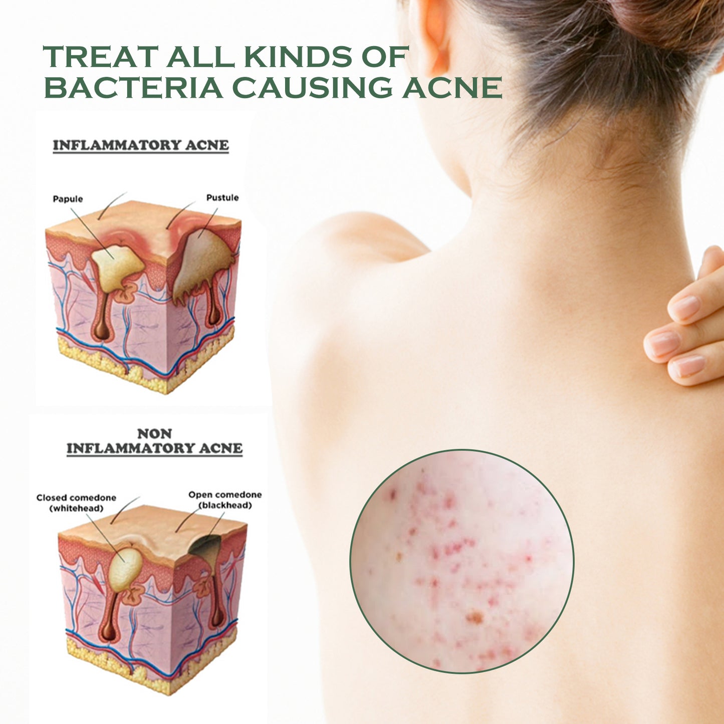 Exfoliating Body Acne Spray - Moisturizing & Skin Clearing Mist 120ml
