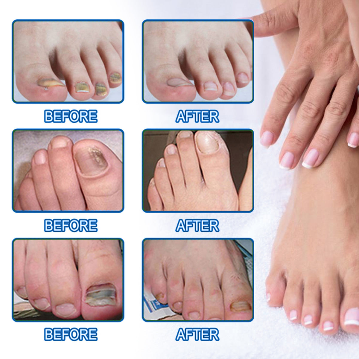 Nail Repair Adhesive Bandages Pack - 32 Patches for Nail Care