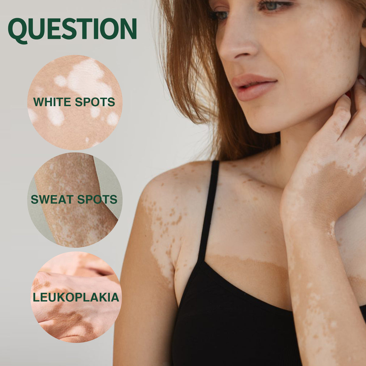 White Spot Repair Cream for Skin Fade & Melanin - 30g