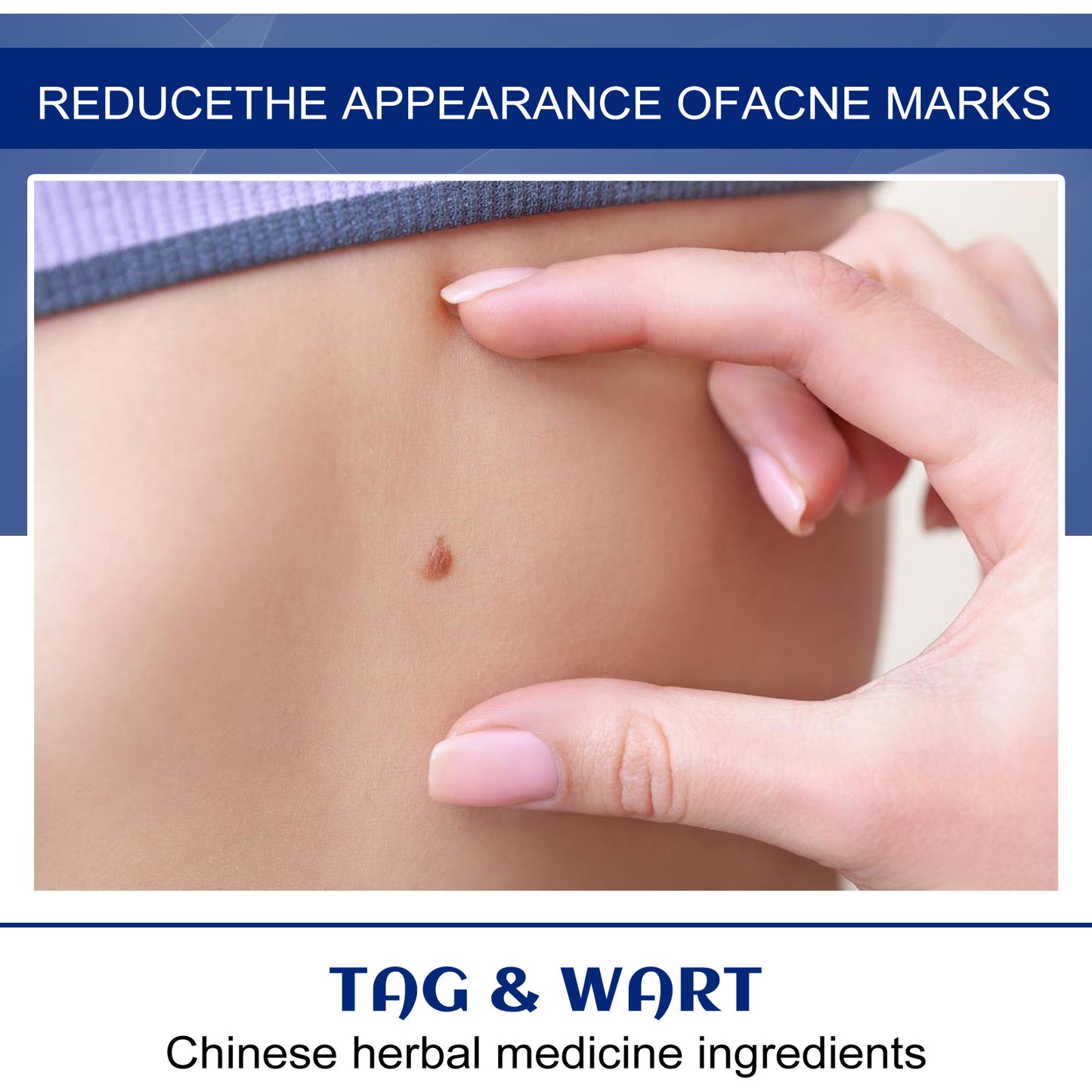 Skin Smoothing & Rejuvenating Body Cream for Wart and Spot Removal
