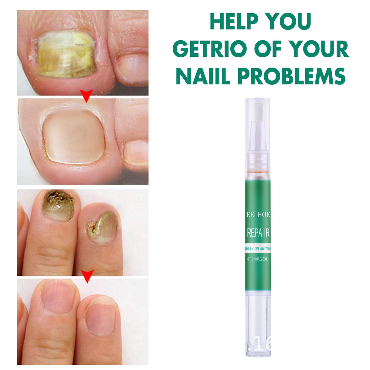 Nail Fungus Repair Pen for Yellow Nails - Onychomycosis Treatment Kit