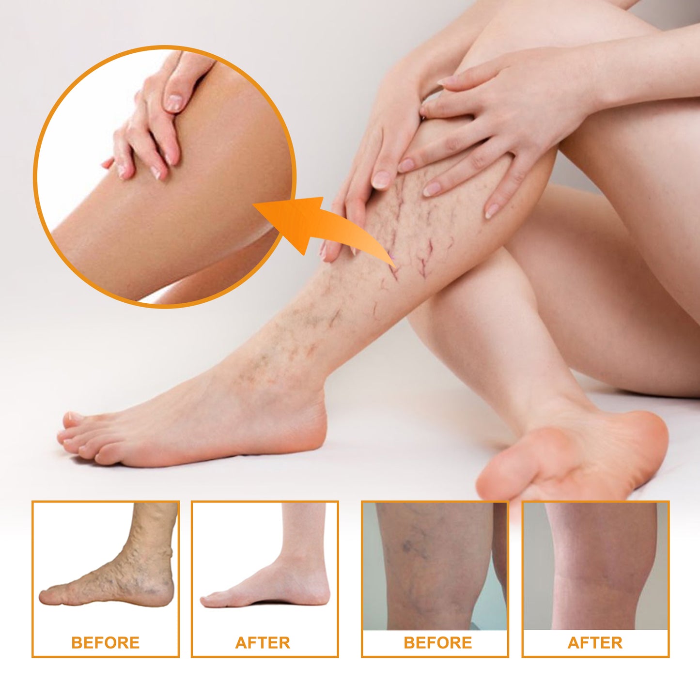 Vitamin K Cream for Varicose Veins and Bruise Relief - Soothing Leg Care