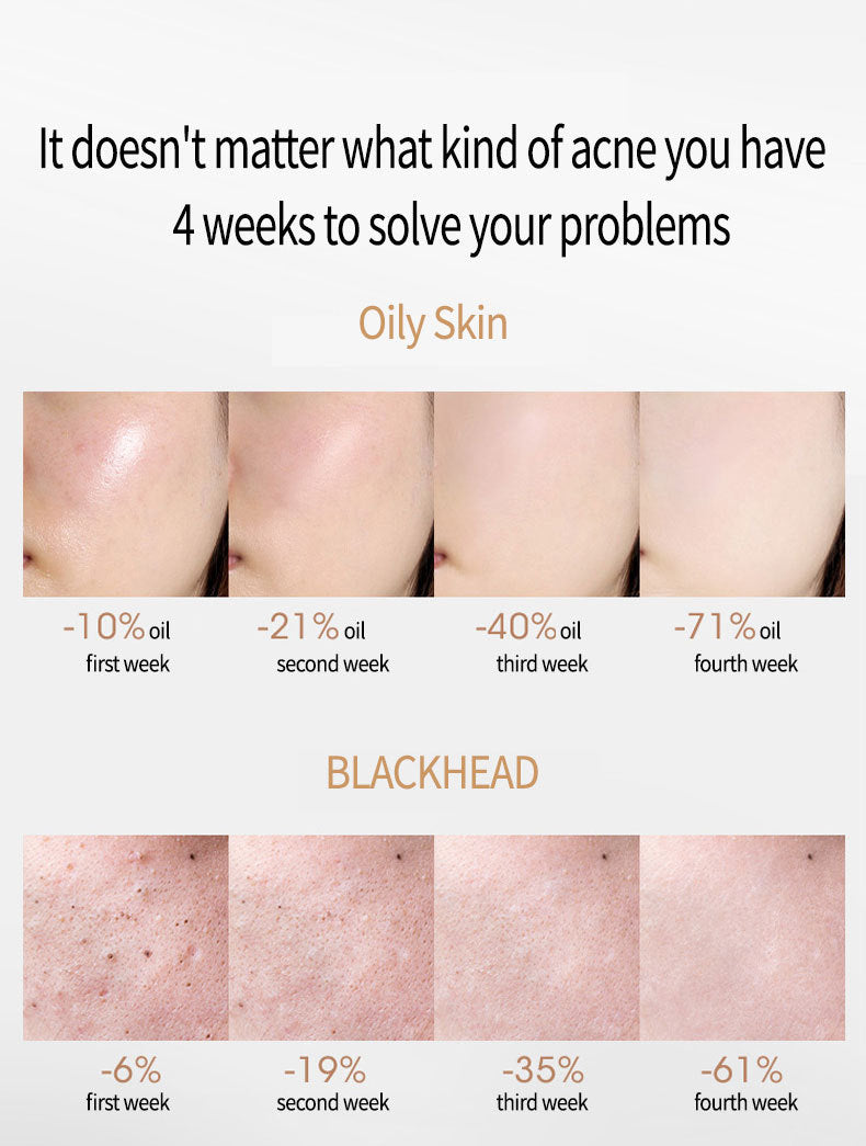 Acne Treatment Serum with Salicylate - Universal Skin Care, 15ml