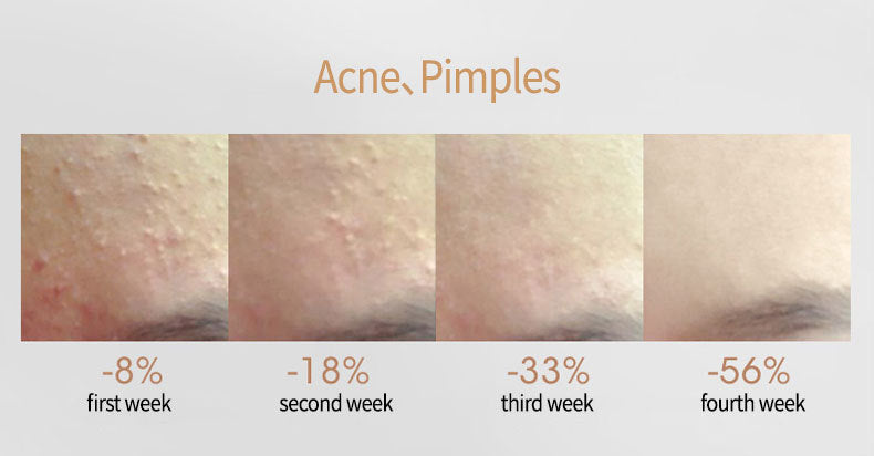 Acne Treatment Serum with Salicylate - Universal Skin Care, 15ml