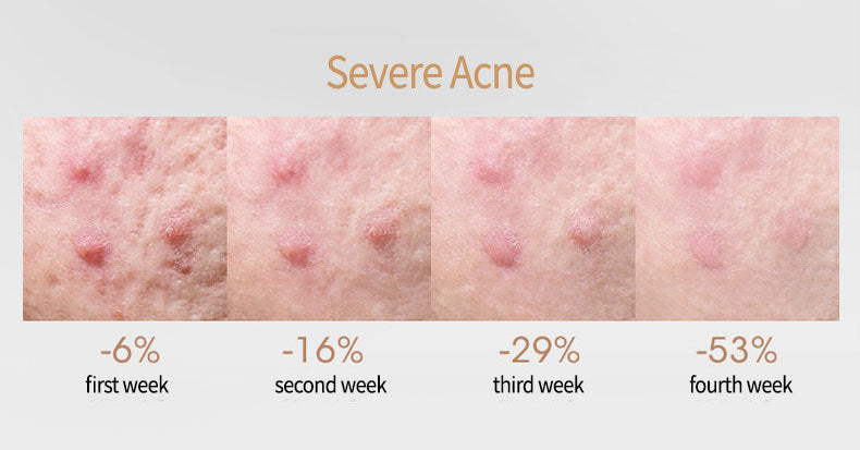 Acne Treatment Serum with Salicylate - Universal Skin Care, 15ml