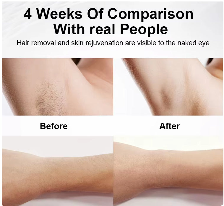 Laser Hair Removal For Brown With Machine