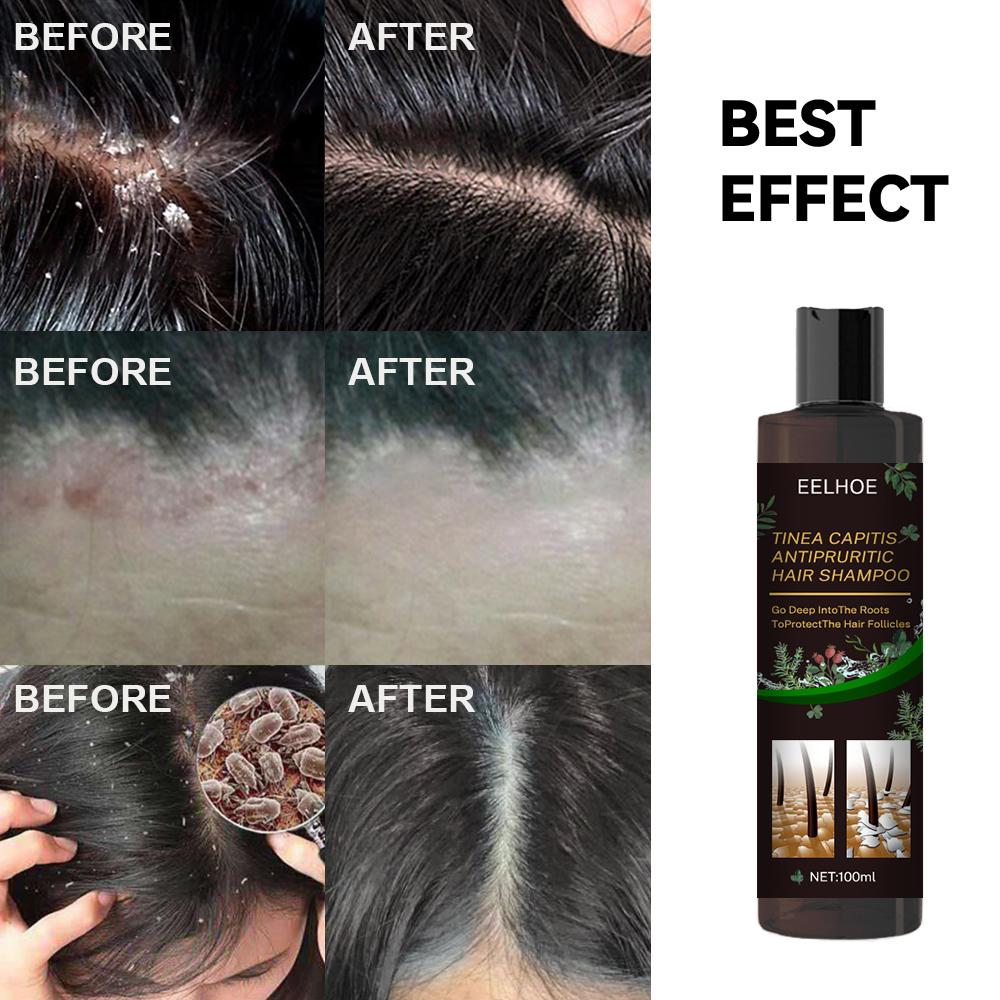 Anti-Dandruff Shampoo for Scalp Itch Relief and Hair Loss Prevention