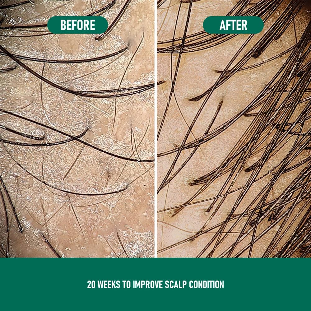 Minoxidil Anti-Hair Loss Mousse for Scalp and Hair Regrowth