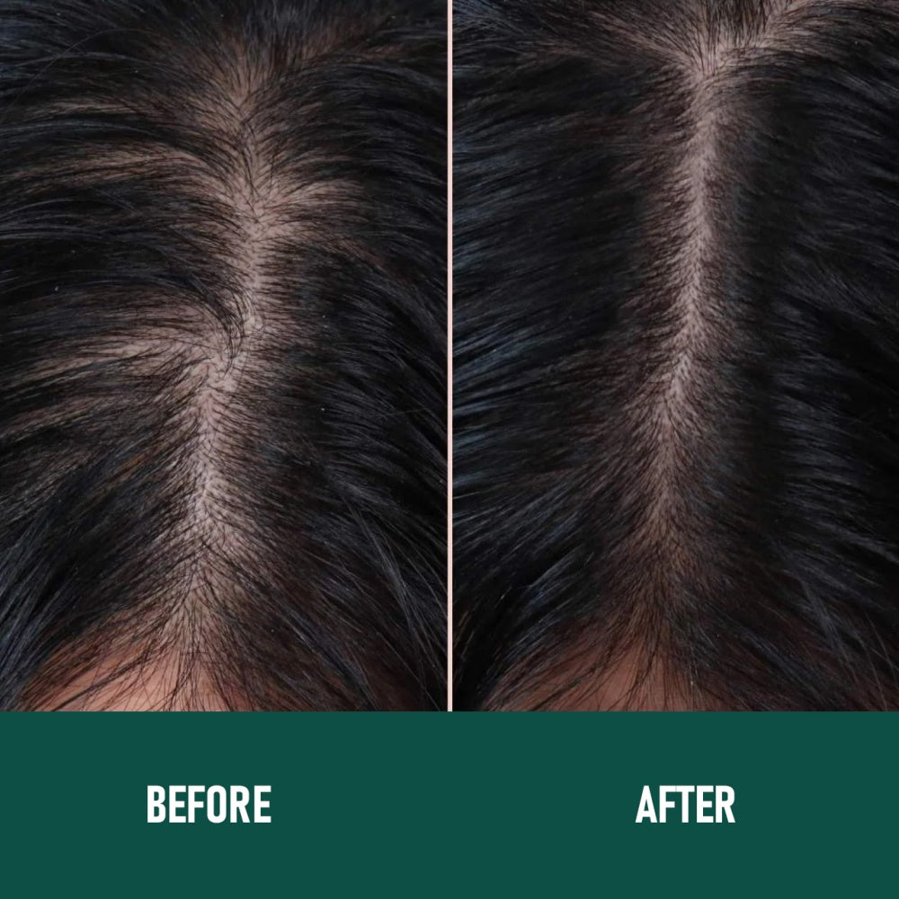 Minoxidil Anti-Hair Loss Mousse for Scalp and Hair Regrowth