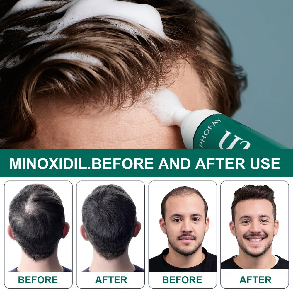 Minoxidil Anti-Hair Loss Mousse for Scalp and Hair Regrowth