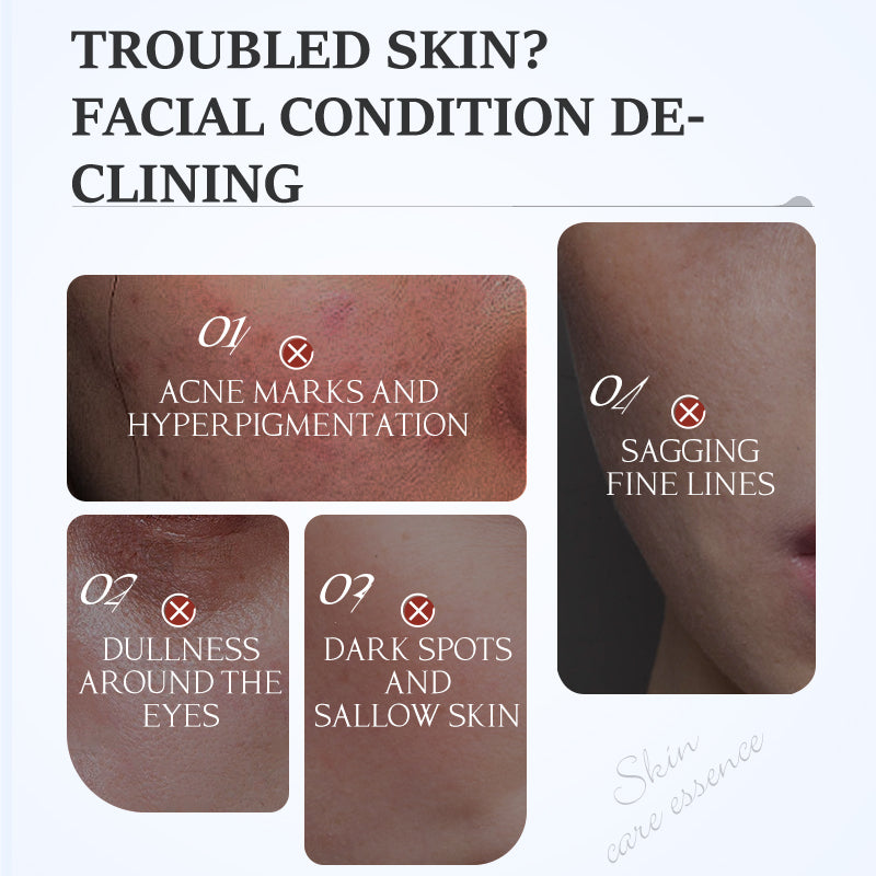 Acne Essence - Targeted Skin Treatment 30ml