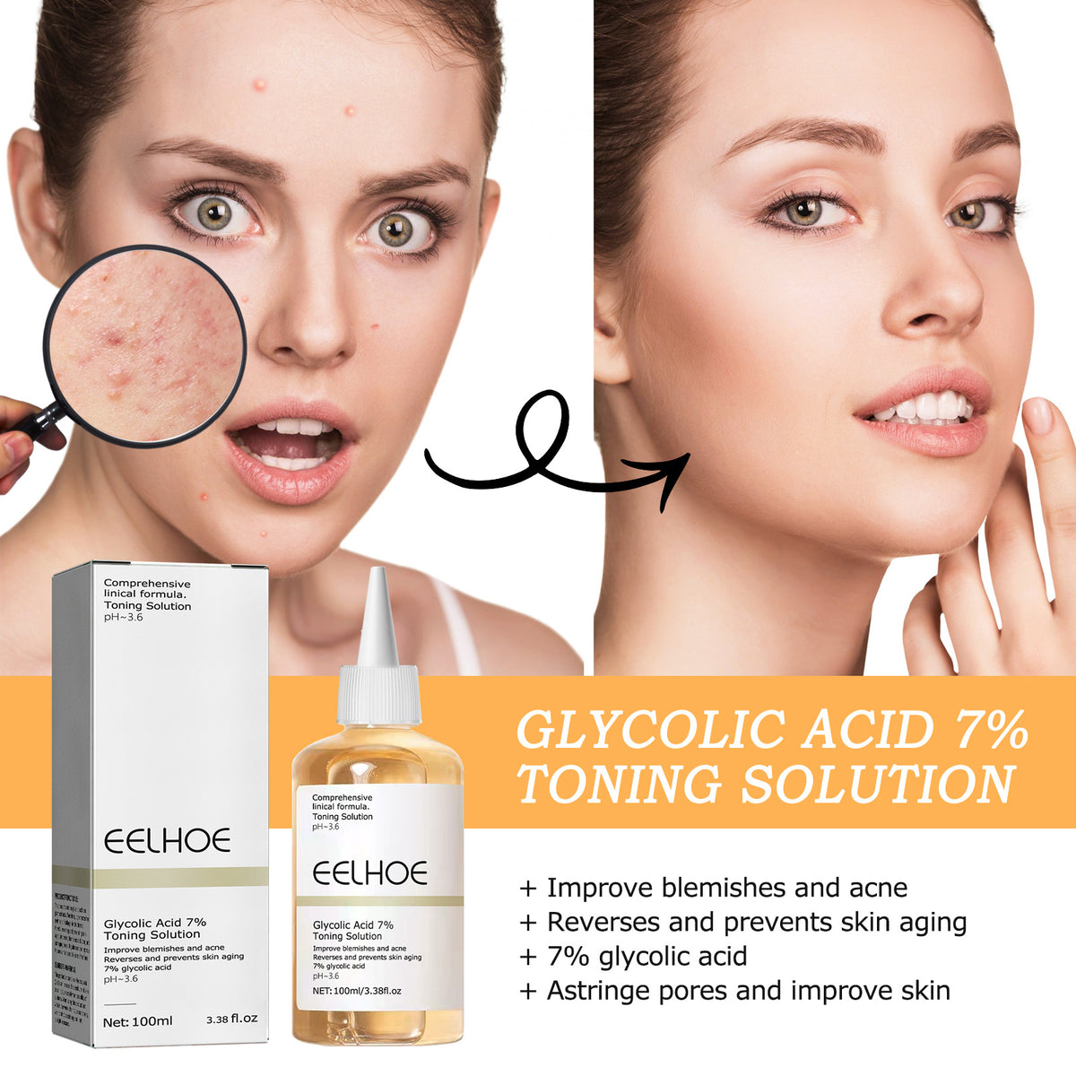 Glycolic Acid 7% Facial Lotion for Acne, 100ml - Moisturizing & Exfoliating