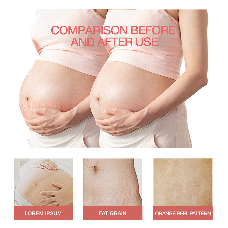 Stretch Mark Oil – 30ml Body Care Serum