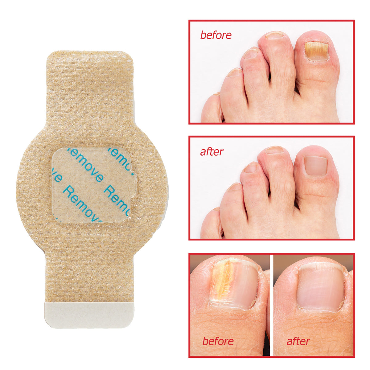 Nail Antibacterial Patch Strengthening Health