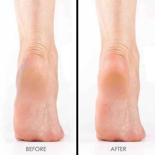 Pumice Stones, Pack of 6 Professional Grade Pumice Stone for Feet, Salon Quality Foot Callus Remover, Double Sided Foot Scraper, Home Manicure and Pedicure Tools