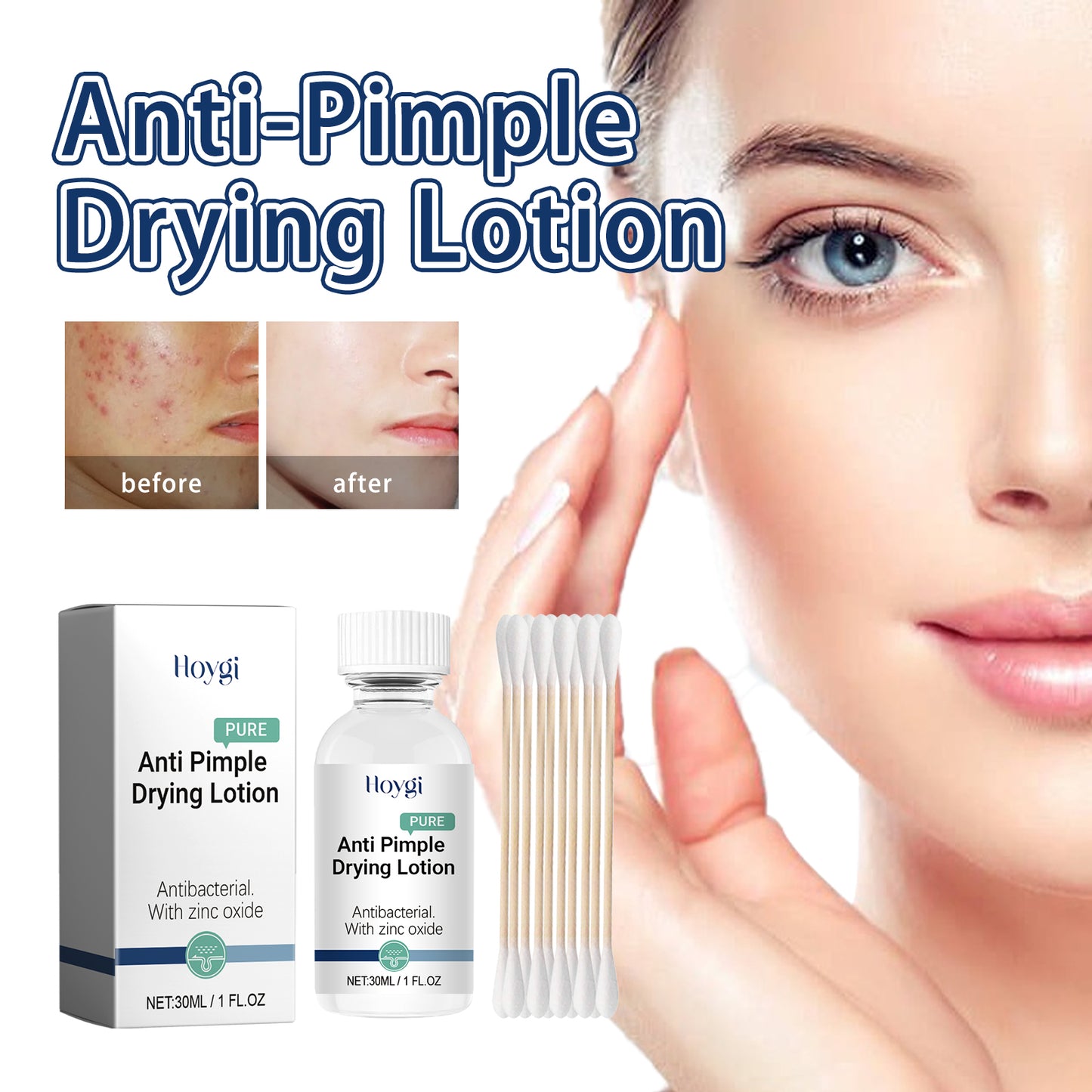 Anti-Pimple Drying Lotion with Salicylic Acid - Acne Spot Treatment