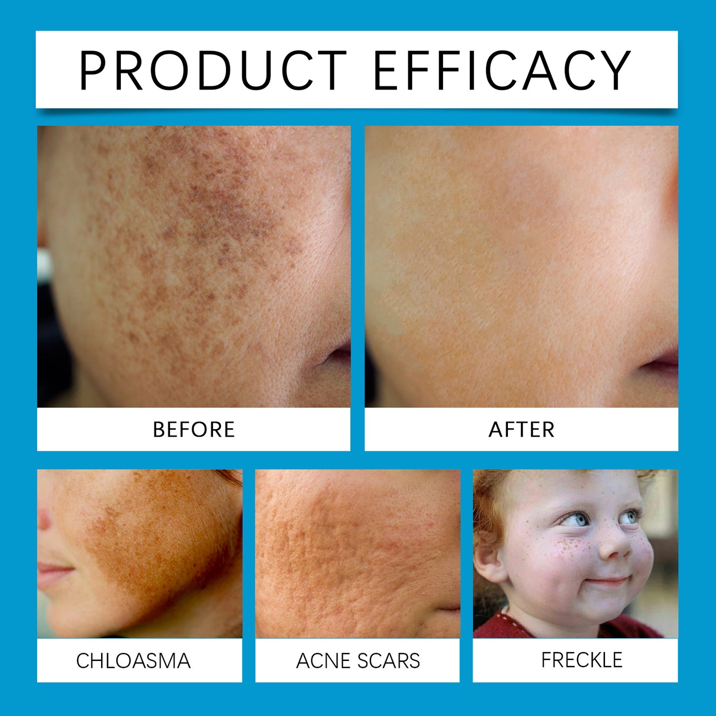 Face Skin Care Laser Pen - Portable Skin Treatment Device
