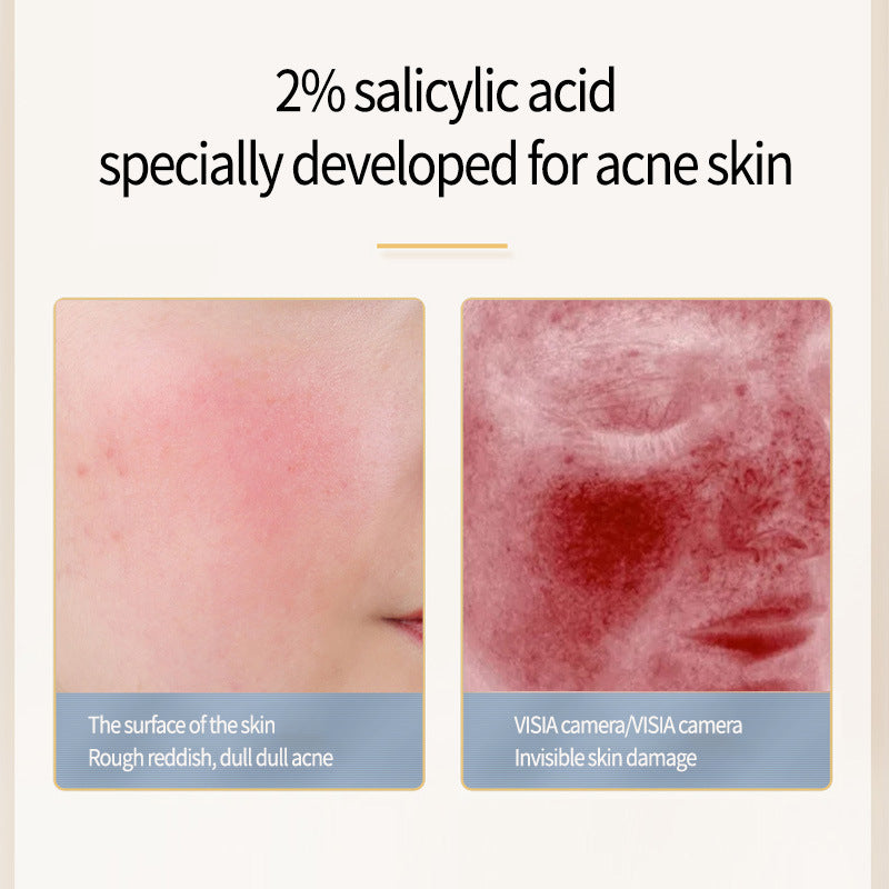 Acne Treatment Serum with Salicylate - Universal Skin Care, 15ml