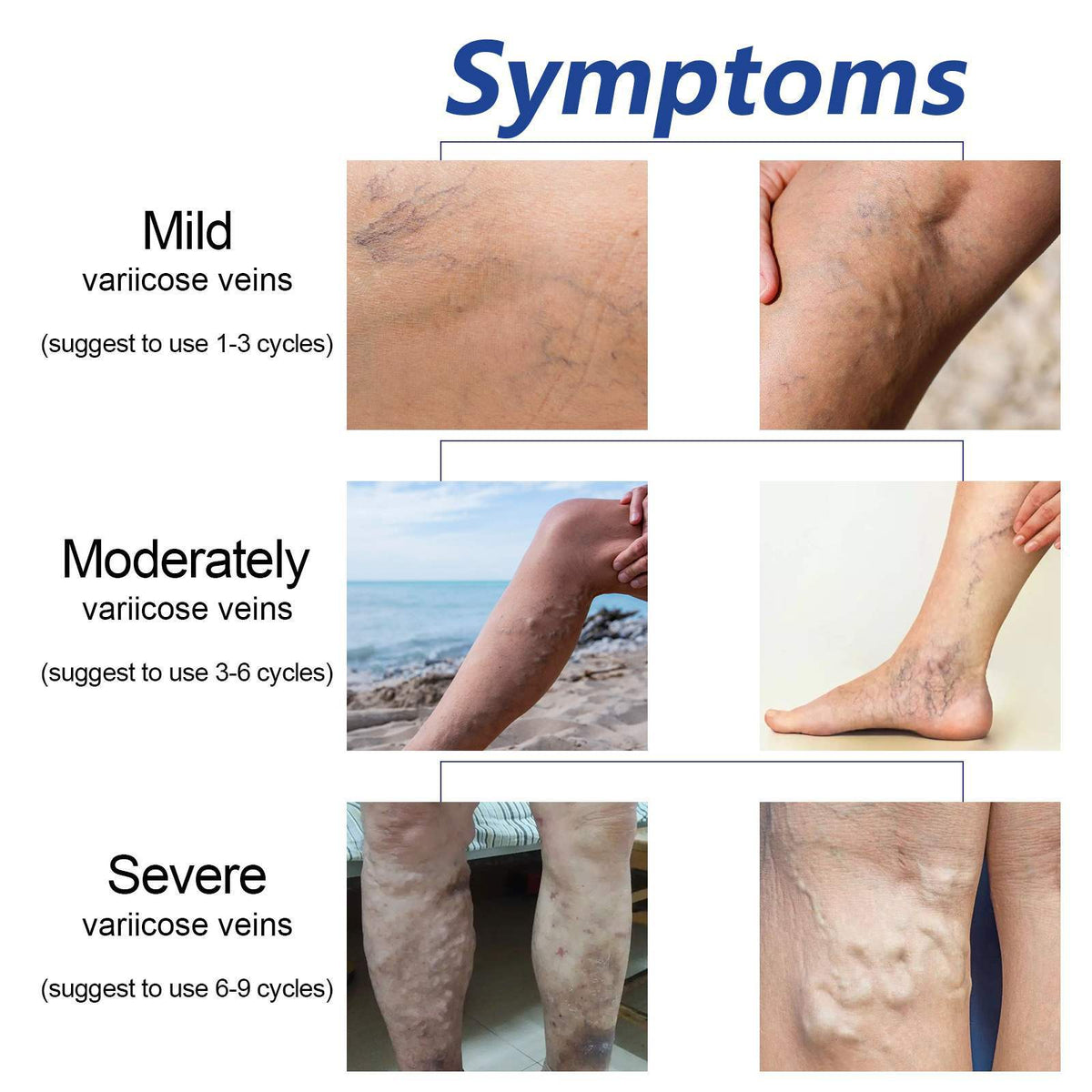 Leg Venous Support Cream for Discomfort Relief 20g - Body Care